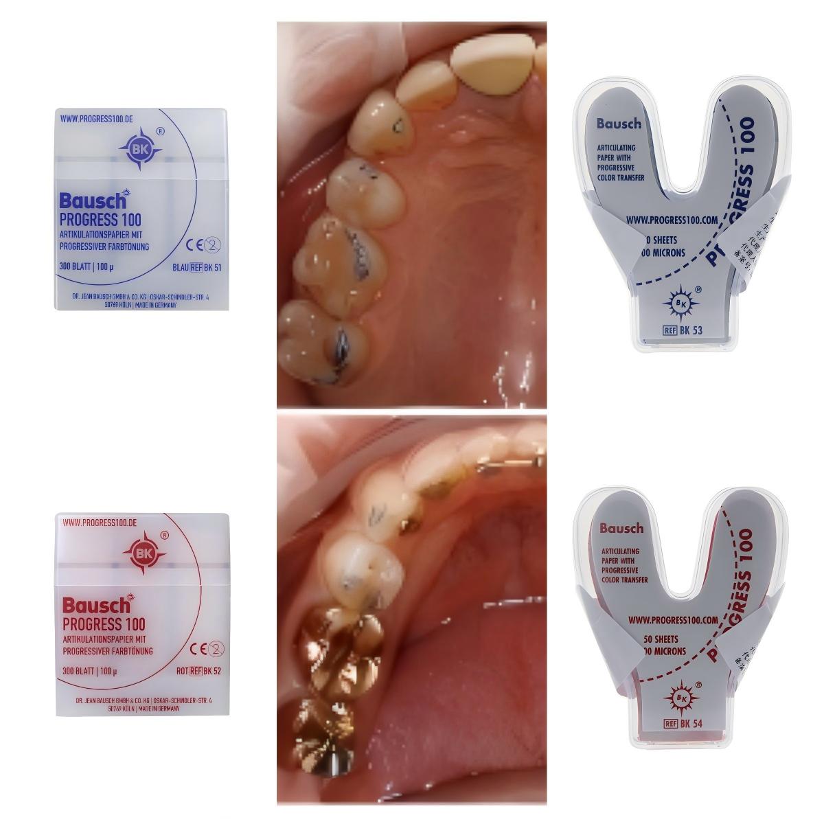 Bausch BK51 BK52 BK53 BK54 Den - đánh giá và giá Bite Indicator